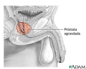 prostata-articulo
